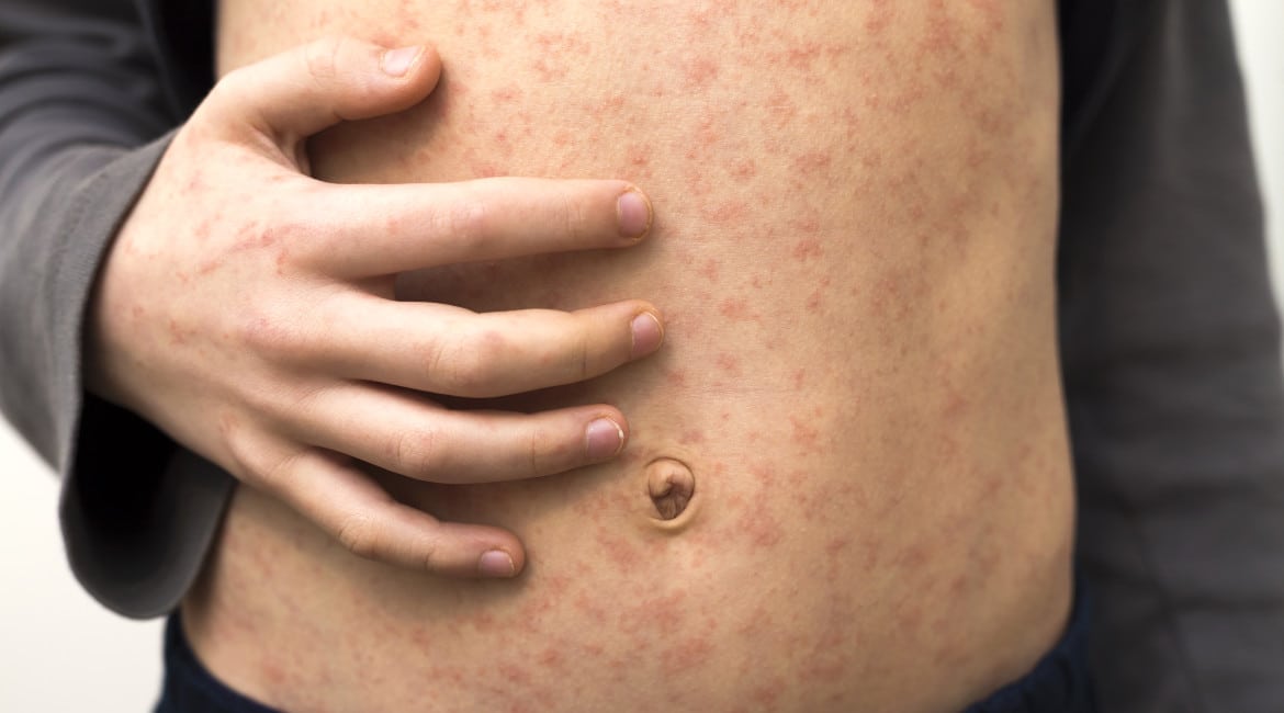 Amoxicillin Rash